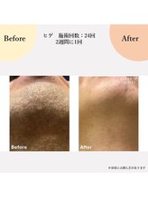 スリール(sourire)/ヒゲ脱毛