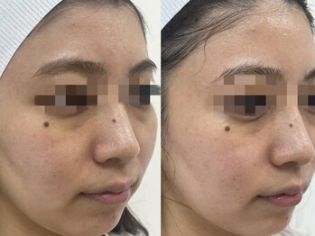 ブルーム(BLOOM)/最先端エステ機器　WISH PRO