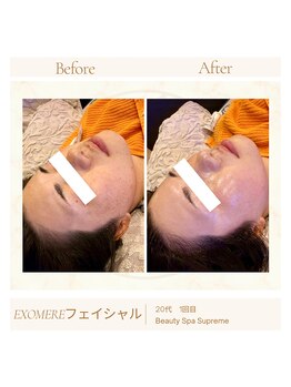 シュプレーム(Supreme)/エクソミアフェイシャル/毛穴無