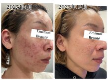 エミマス ボーテ(Emimas Beaute’)/汚肌からエステでも変われる！