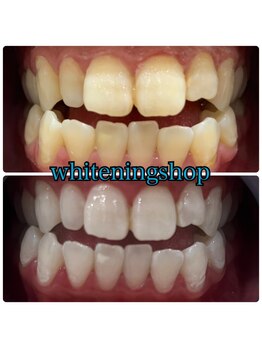 ホワイトニングショップ 加古川店/お客様のビフォーアフター