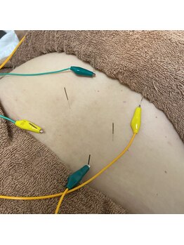 アボット(ABBOTT)/腰痛撃退☆鍼灸施術