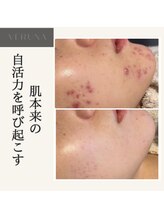 リレア ラカ(Relair Laka)/VERUNAハーブピーリング