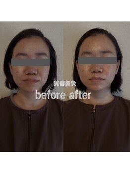 ウーマンビーヘルス(woman Be Health)/お試し美容鍼灸60分