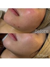 アテ 国分寺店(Ate)/慢性的な赤み、ニキビケア