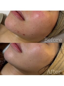 アテ 国分寺店(Ate)/慢性的な赤み、ニキビケア