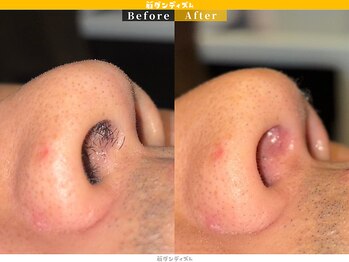 眉ダンディズム 大阪天神橋六丁目店/鼻毛Before/After