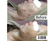 チュベルフェ(tu belle fe)/羊膜幹細胞◆水光ジェット◆