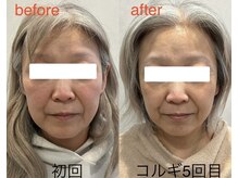 ビーキュート 学芸大学店(BE-CUTE)/Before/After　施術