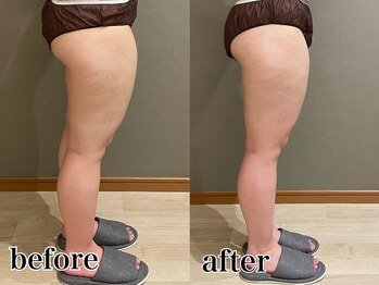 メロウ(me: llow)/ハイパーナイフEX/恵比寿エステ