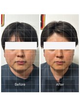 ダンニヒル(dannihil)/【小顔矯正】20代学生2回目