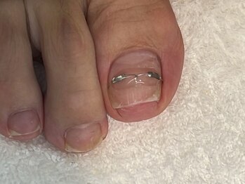 巻き爪/トラブルネイルも大歓迎!