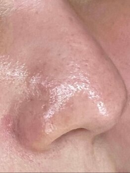 サロンリアンジュ ひたちなか店(Salon Liange)の写真/【毛穴開きに◎】3種の酸で毛穴洗浄×EMS引き締め♪イオン導入20倍!美容成分を浸透させ内側からの潤いを!