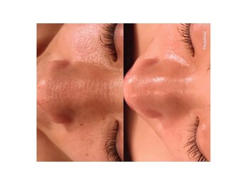 サロン ド ヒノキ(Salon de HINOKI)/毛穴ケア