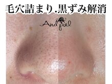 アンドピエル(AndPiel)/毛穴トラブルはお任せください！