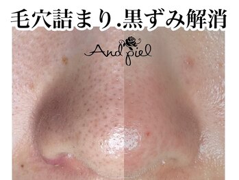 アンドピエル(AndPiel)/毛穴トラブルはお任せください！