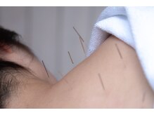 アキュパンクト ラボ 片山治療院(Acupunct Lab 片山治療院)/肩こり