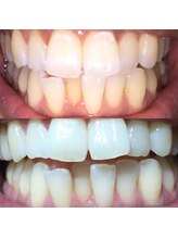 ティースクリーン(Teeth Clean)/セルフホワイトニング4セット