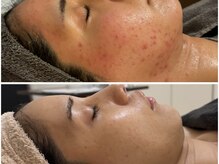 サロン ベビーフェイス(SALON BABY FACE)の雰囲気（肌質の根本改善/毛穴・ニキビケア/赤みの鎮静）
