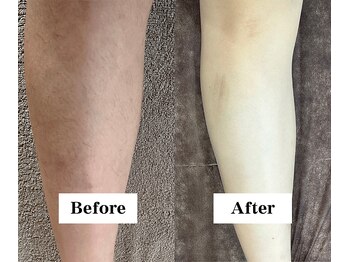 ワイイーサロン(Y/E SALON)/【20代女性　全身脱毛】