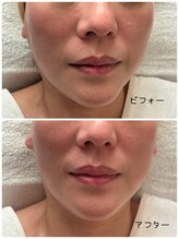 ナナプラス(nana plus)/むくみケア