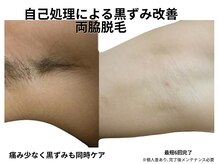 エイチケービューティーサロン(H/K beauty salon)/【最短6回の両脇脱毛】