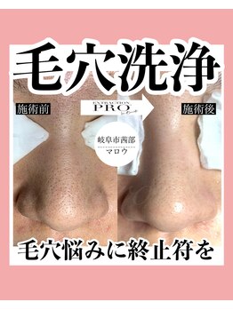 サロン マロウ(SALON Marrow)の写真/毛穴エクストラクションプロ認定サロン◇毛穴の汚れ・黒ずみ・角栓をごっそり取り除き、お肌のトーンUP♪