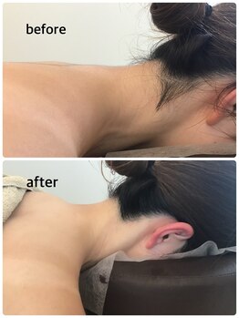 アジサイ(Ajisai)/結果重視の脱毛