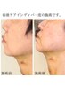 【DT/術前後インディバ30分】初回お試し/痛み/硬さ/むくみ/凸凹ケア¥5000
