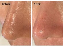 ハーシークレット(Her secret)/ハイドラ毛穴洗浄