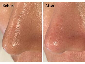 ハーシークレット(Her secret)/ハイドラ毛穴洗浄