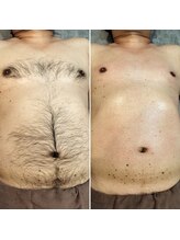 シャンティ(Shanti)/メンズワックス脱毛