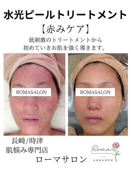 ローマサロン/赤みケア◎