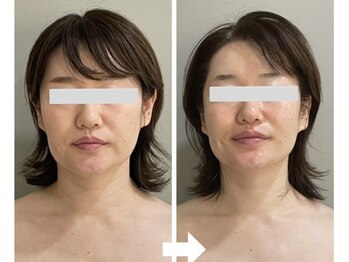 マグノリア/小顔パルス美容鍼