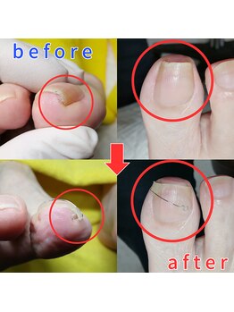 【巻き爪】ネイル/フット