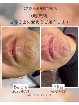 オフ(off)/ヒゲ脱毛