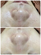 メイユール(MEILLEUR)/光フェイシャル1回