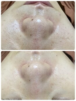 メイユール(MEILLEUR)/光フェイシャル1回