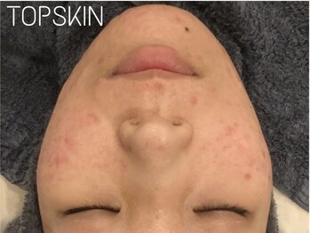 トップスキン 名駅(TOPSKIN)/ハーブピーリング認定講師在籍