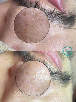 レーヌ(Reine)/毛穴エクストラクションフォトRF