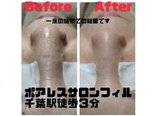 ポアレスサロン フィル(fil)/1回での施術結果☆