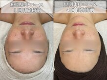 サロンノワ(salon noix)/《メイクで隠さないお肌に》