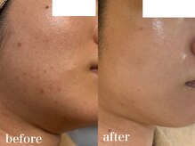 ホワイトアクア 北千住店(WHITE AQUA)/ハーブピーリング/ニキビ