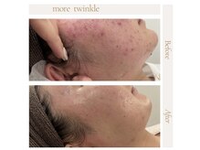 モアトゥインクル 福山宮通り店(MORE twinkle)の雰囲気（脱毛しながら肌改善(^^)自信が持てる美肌に☆）