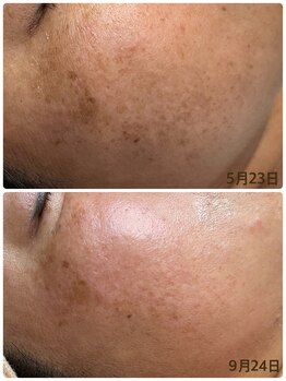 ミハン ボーテ(mihan.beaute)/【しみ・くすみ・乾燥】