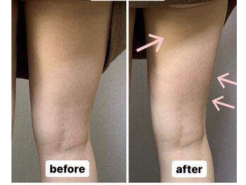 新生堂 新横浜店/痩身キャビテーション