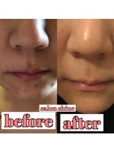 サロンシャイン(Salon Shine)/ハーバルピールレベル７