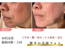 トレース/美顔フォトの効果（40代女性）