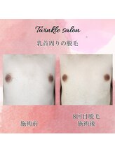 ティンクル サロン(Twinkle salon)/乳輪周りの脱毛