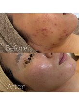 アテ 国分寺店(Ate)/繰り返さないニキビケア